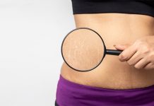 Зашто се појављују стрије Жена под лупом показује стрије