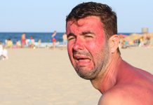 Kако да вам алергија на сунце не упропасти летовање Мушкарац плаче након задобијених опекотина од сунца