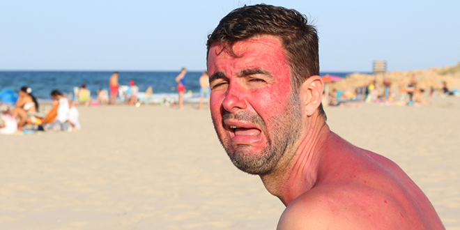 Мушкарац плаче након задобијених опекотина од сунца