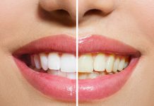Ове намирнице су кривац за жуте зубе Женски зуби — Пре и након избељивања зуба
