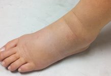 Отичу вам ноге од врућине? Ево шта треба да радите! Отечена нога и стопало