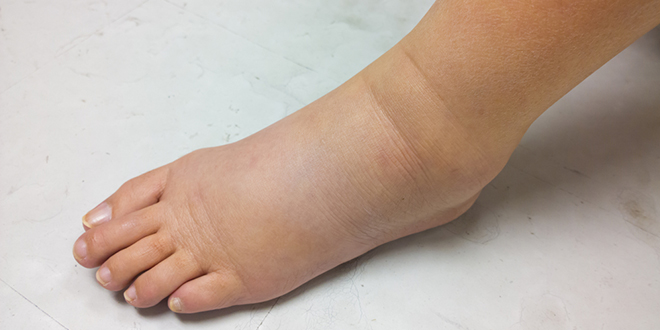 Отечена нога и стопало