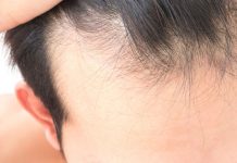 Ћелавост постаје ствар прошлости? Отворена прва банка косе на свету! Мушкарац показује знаке губитка косе, ћелавости