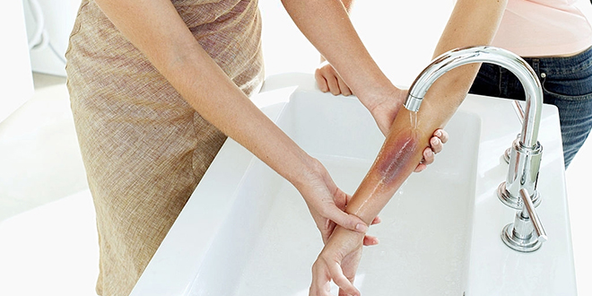 Опекотина на руци под млазом хладне воде